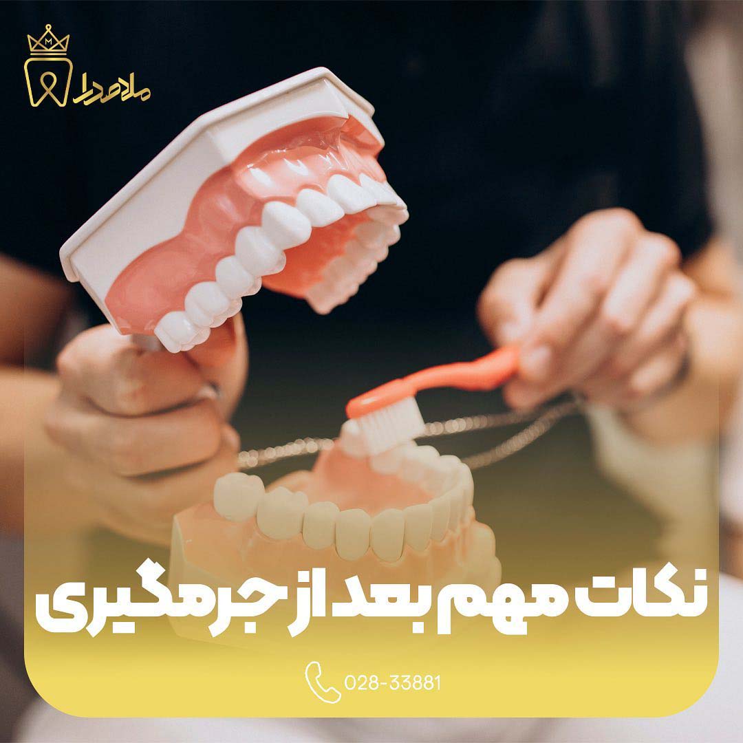 نکات مهم بعد از جرم گیری